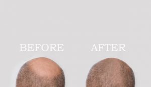 Read more about the article Medical Hair Restoration