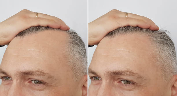 hair restoration results Lahore