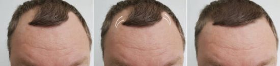 hair loss causes and treatment Lahore