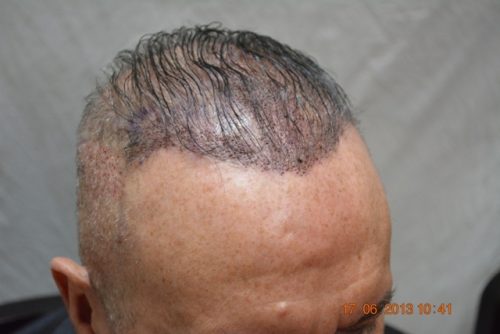 Reviews of hair transplant in Pakistan