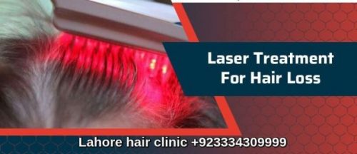 Laser treatment for hair loss
