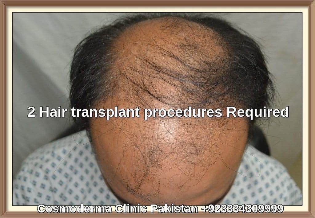 Male pattern baldness treatment Lahore