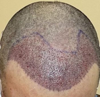 Cheap hair transplant Lahore