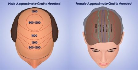 You are currently viewing Hair transplant Spain