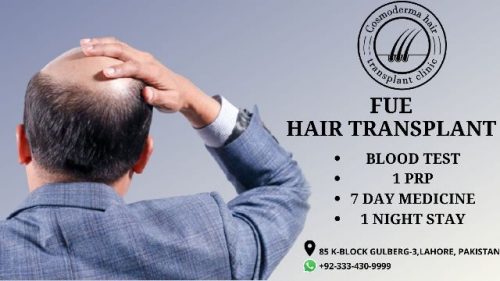 Read more about the article Hair transplants