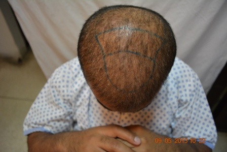 Third session by Fue hair transplant in Pakistan