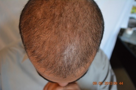 Third session for mid scalp area