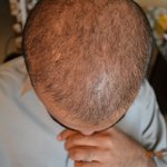 hair transplant in Pakistan two sessions result