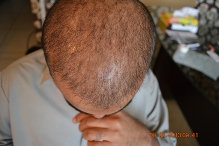 hair transplant in Pakistan two sessions result