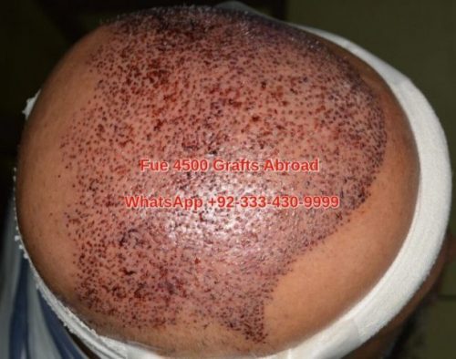 hair transplant in Belgium