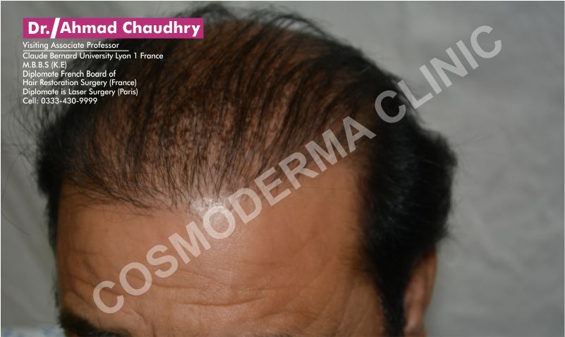 hair loss solution Pakistan Lahore