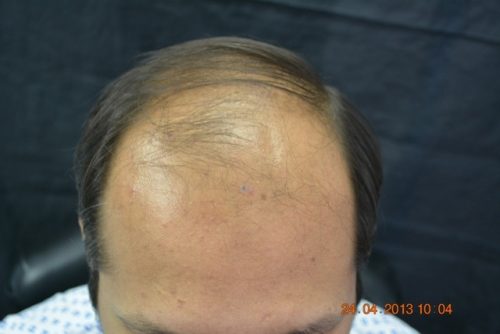 Hair transplant Holland