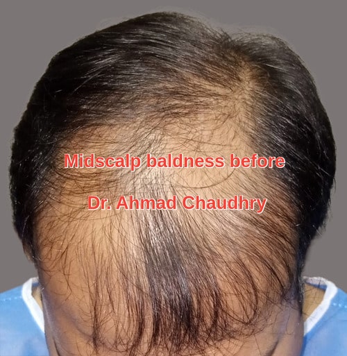 Baldness before procedure