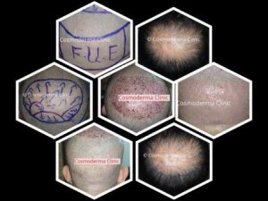 Read more about the article FUE Hair transplant Switzerland
