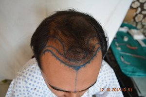 Hair transplantation in Germany