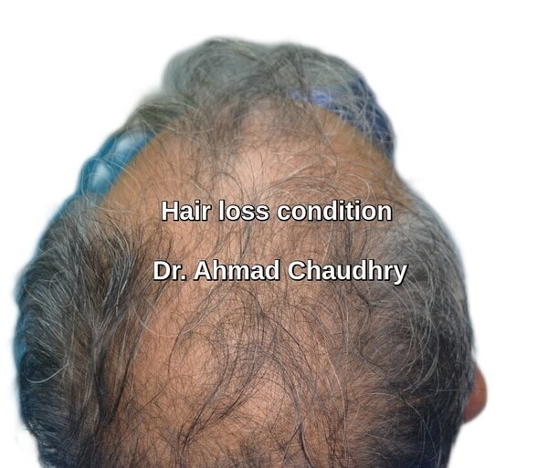 Hair loss treatment Australia