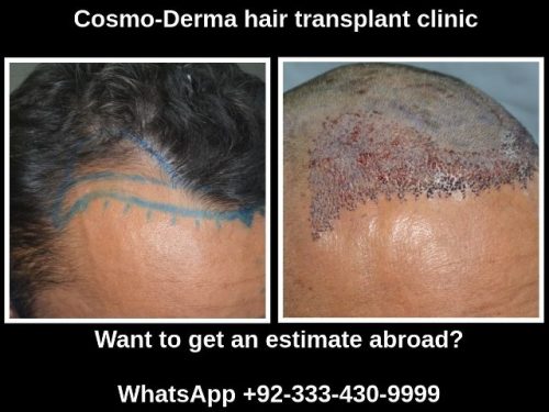 You are currently viewing Hair Transplant Cost Australia