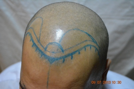 hair transplant cost Spain