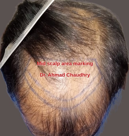 Treatment area marking mid scalp