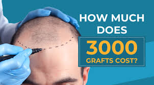 cost of hair transplant in Pakistan