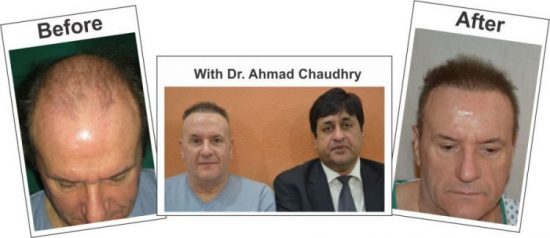 Fue hair transplant before and after result Lahore