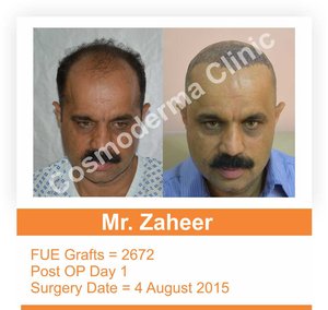 Fue hair transplant in Lahore