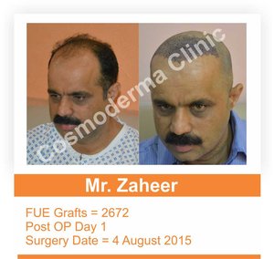 Fue hair transplant recovery time