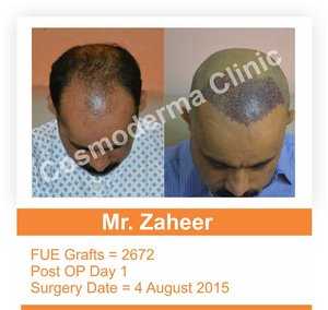 Fue hair transplant success rate