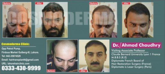 Hair transplant clinic Lahore