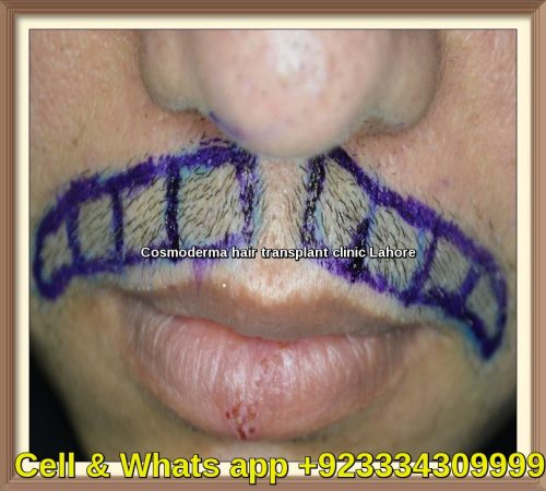 Mustache hair transplant clinic Lahore