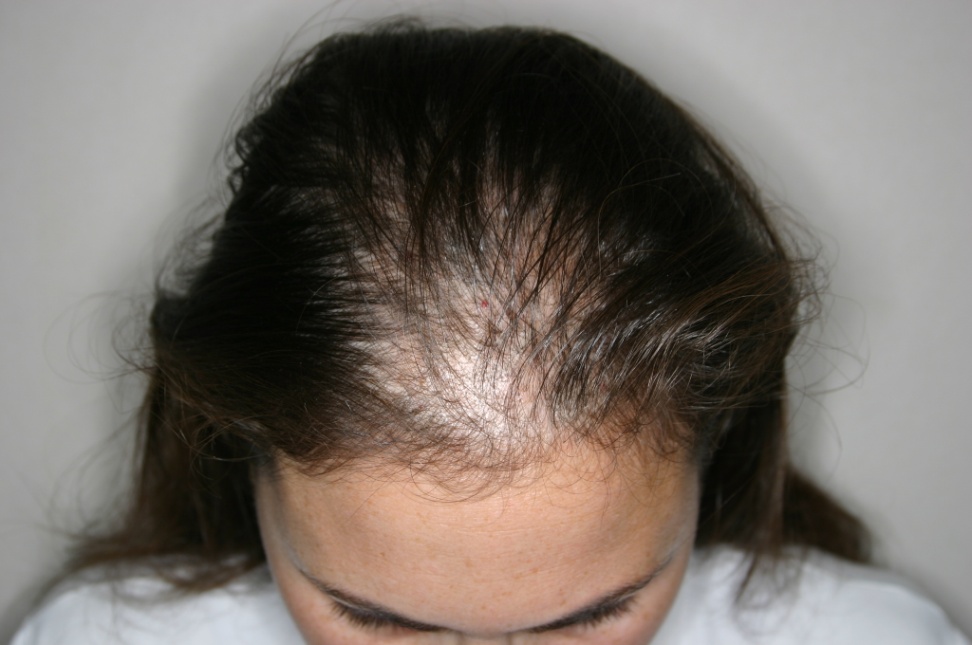  hair loss treatment for women in Lahore 