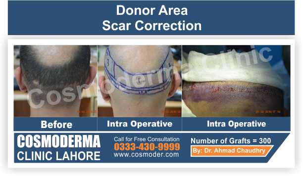 Hair Transplant donor scar repair