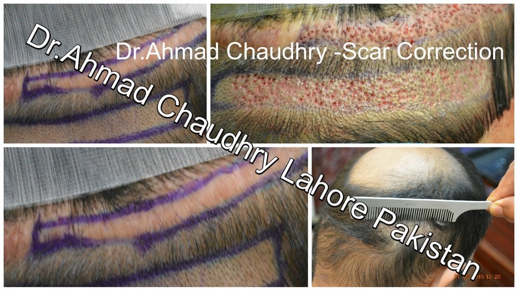 hair-transplant-donor-scar-repair-result-lahore