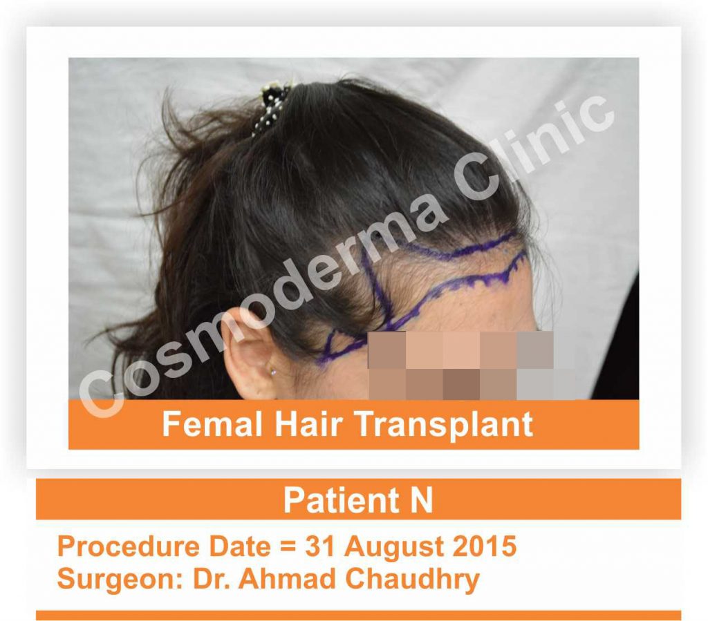 Female hair thinning treatment Lahore