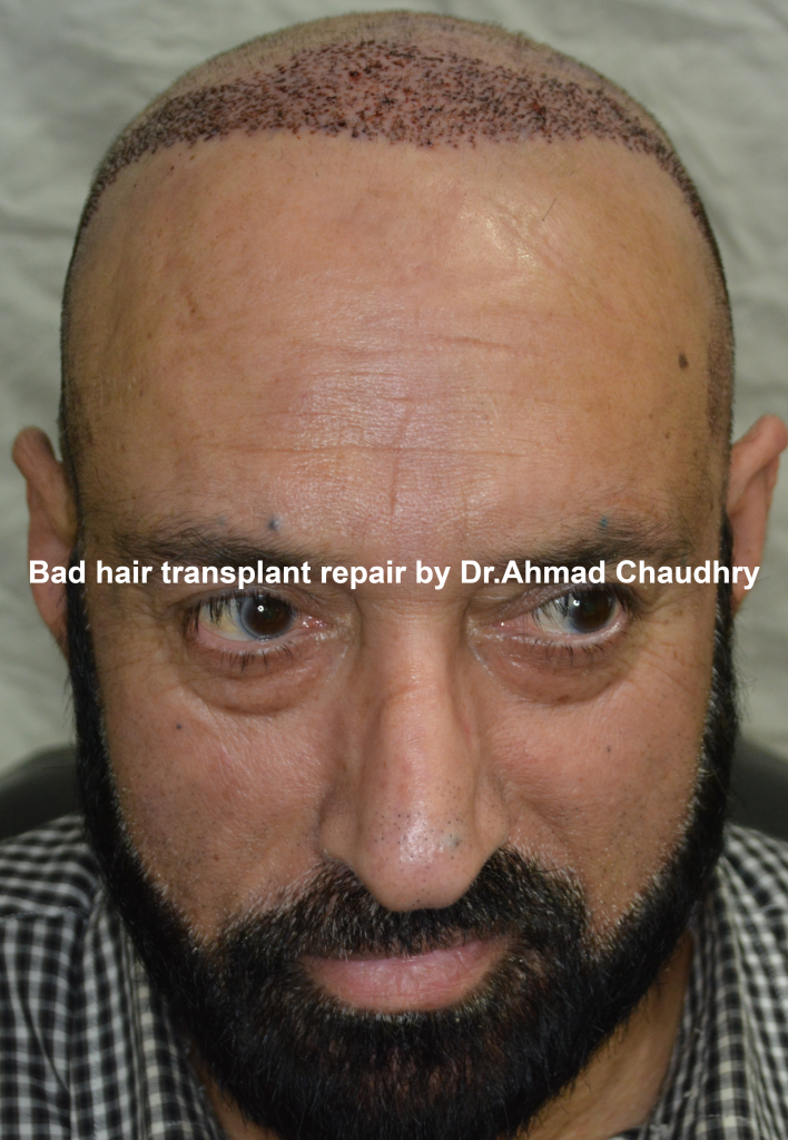 Bad hair transplant repair Lahore Pakistan