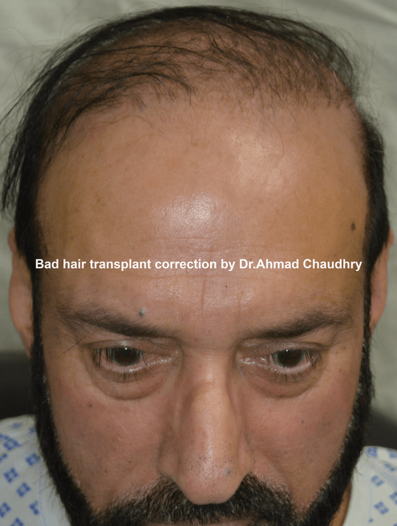 bad hair transplant correction
