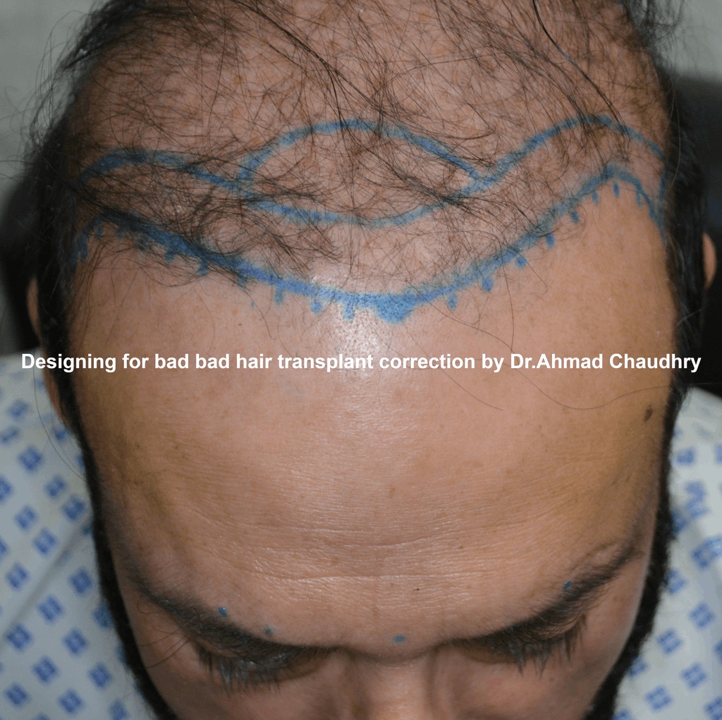 bad hair transplant repair designing