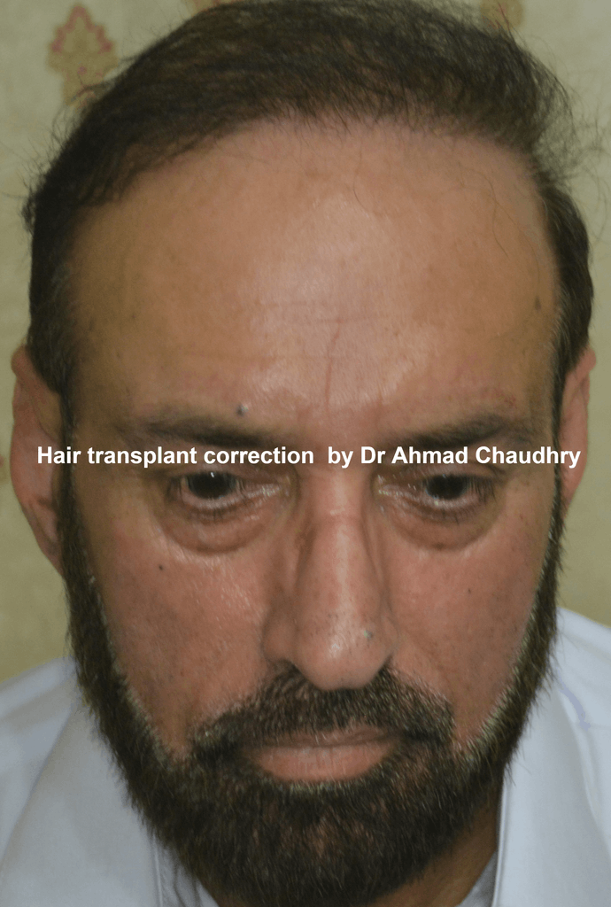 hair transplant correction results Lahore Pakistan