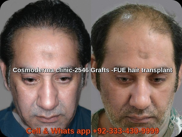 2500-grafts-hair-transplant-before-after-results