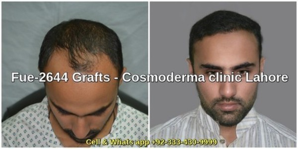 2644-grafts-results-lahore