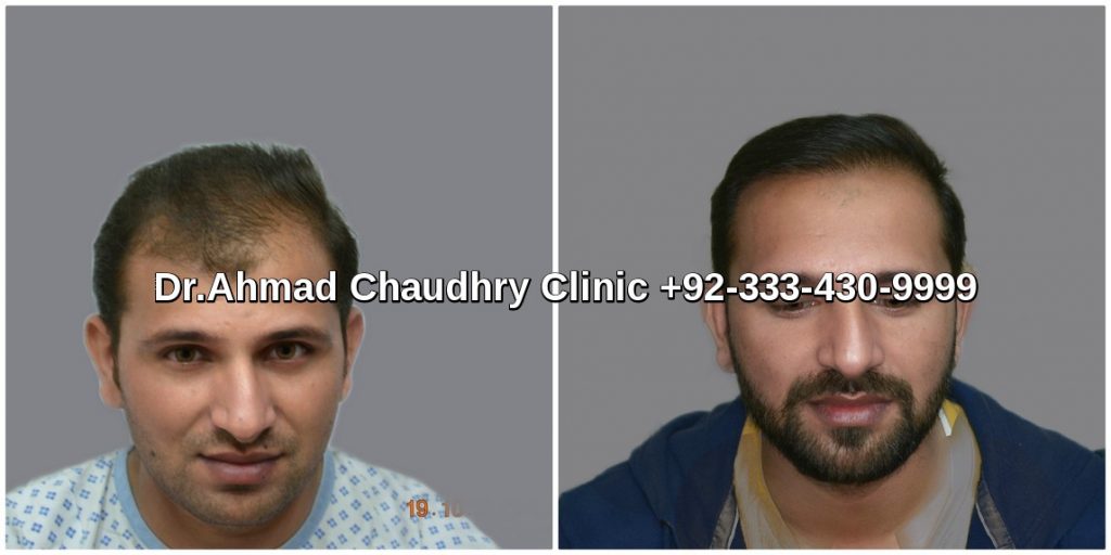 3000-grafts-hair-transplant-cost-in-Pakistan