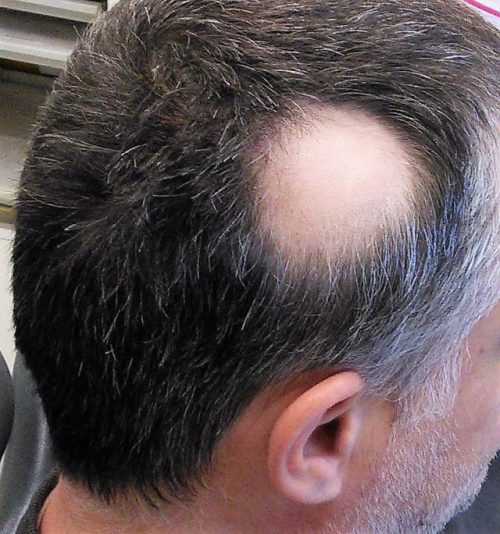 Alopecia_areata-treatment-clinic-lahore