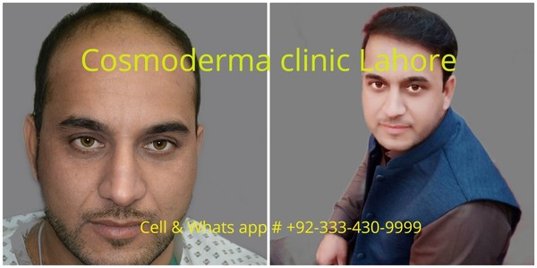 FUE-2900-grafts-Cosmoderma-clinic-best-hair-surgeon-Lahore