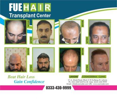 Best hair transplant results