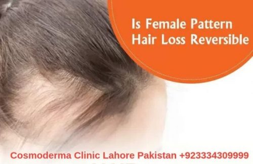 Female pattern hair loss