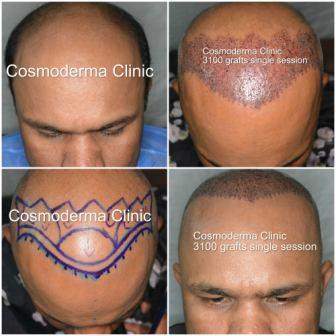 How successful is a Hair Transplant Lahore Pakistan