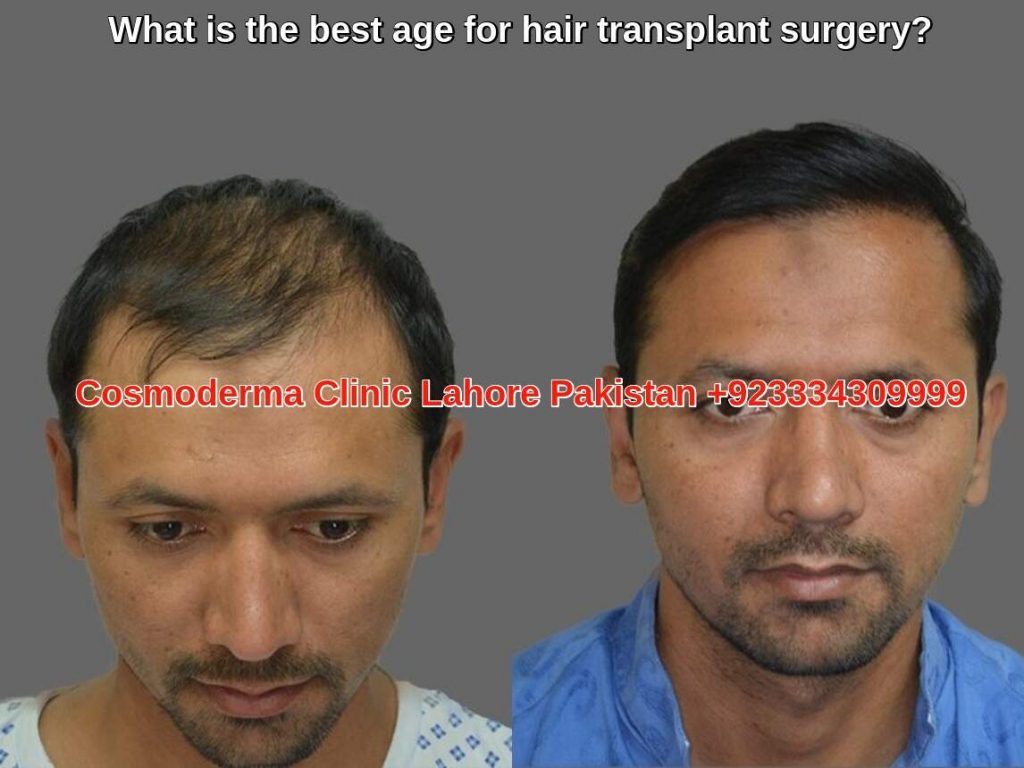 Hair transplant candidacy