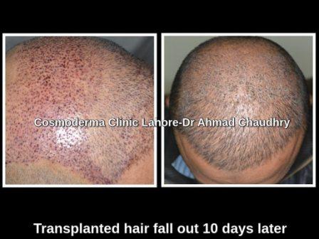 You are currently viewing Transplanted hair fall out