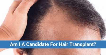 best age for hair transplant