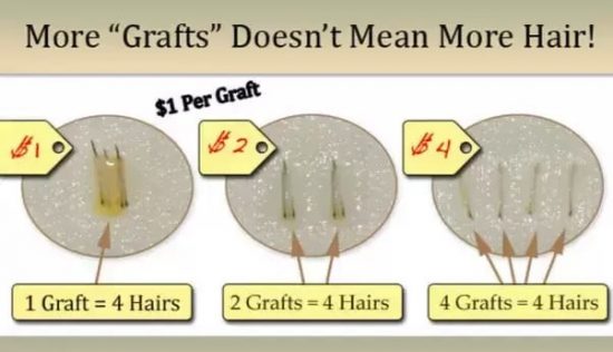 hair graft cost